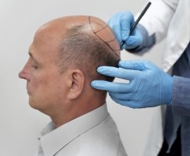 mature-man-going-through-follicular-unit-extraction-process (3)